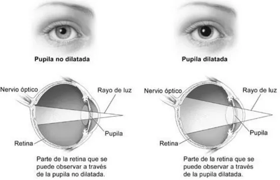 Figura 1.4:  Diferencia entre la observación del fondo de ojo con la pupila no dilatada y la pupila dilatada  (Fuente: National Eye Institute, National Institutes of Health).