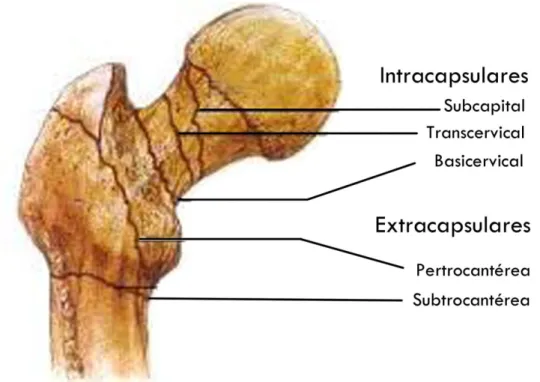 Figura 3. Clasificación anatómica de las fracturas del tercio proximal del fémur.                         Modificado de URL: http://formacionenemergencias.blogspot.com.es/2012/06/fractura-de-           