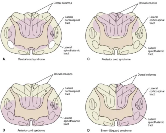 Figura 7: Lesiones medulares incompletas.  http://z0mbie.host.sk/Emergency-Treatment-of-the-Spine-Injured- http://z0mbie.host.sk/Emergency-Treatment-of-the-Spine-Injured-Patient.html