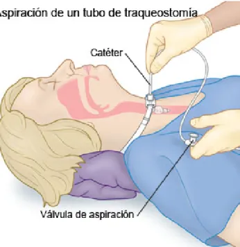 Figura 13:  http://www.drugs.com/cg_esp/cuidados-de-la-traqueostom%C3%ADa.html