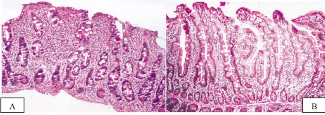 Figura 1. Microscopía óptica de mucosa intestinal de enfermo celíaco  no tratado (A) frente a paciente sano (B)