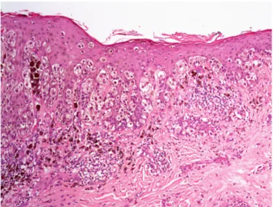 Figura I.4 Melanoma de extensión superficial: melanocitos atípicos ascendiendo por  la epidermis hasta el estrato granuloso.