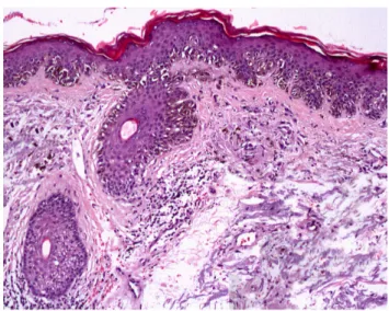 Figura I.6 Lentigo maligno melanoma
