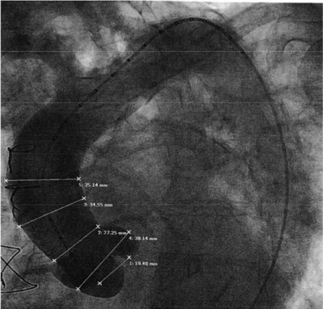 Figura  3.3.  Ejemplo  de  aortografía  (proyección  oblicua  craneal  izquierda)  realizada con el catéter “pig-tail” centimetrado 