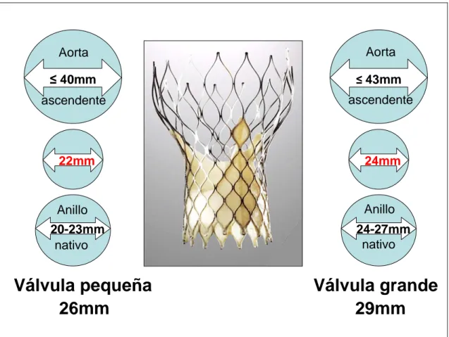 Figura 3.7. Características y diámetros de los tipos de prótesis aórtica CoreValve® 