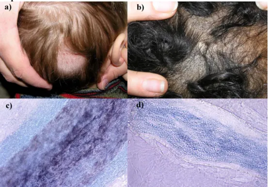 Figura 3. Tinea capitis no inflamatoria.  