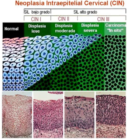 Fig. 1. Neoplasia Intraepitelial Cervical (CIN) 