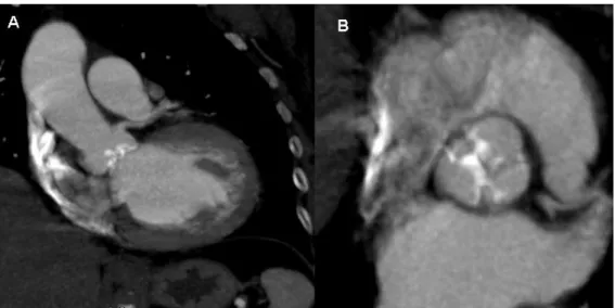 Figura 7. Evaluación del aparato valvular aórtico y aorta con TAC.  
