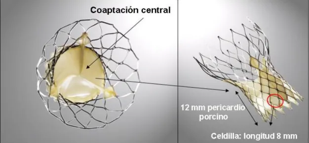 Figura 9.  Prótesis aórtica CoreValve ®