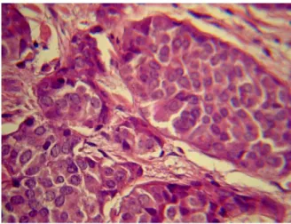 Figura 1. Tumor carcinoide de apéndice. Patrón  sólido, conformado por nidos de células tumorales, 