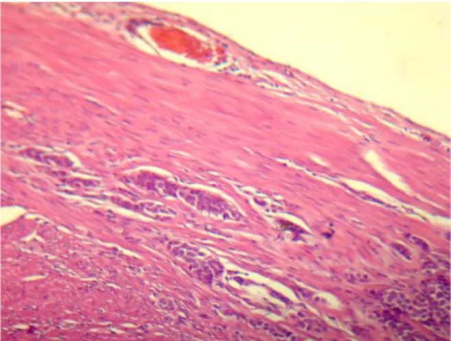 Figura 2. Tumor carcinoide de apéndice con  infiltración a la capa muscular y angioinvasión 