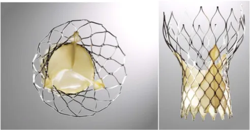 Figura 3. Prótesis aórtica CoreValve 