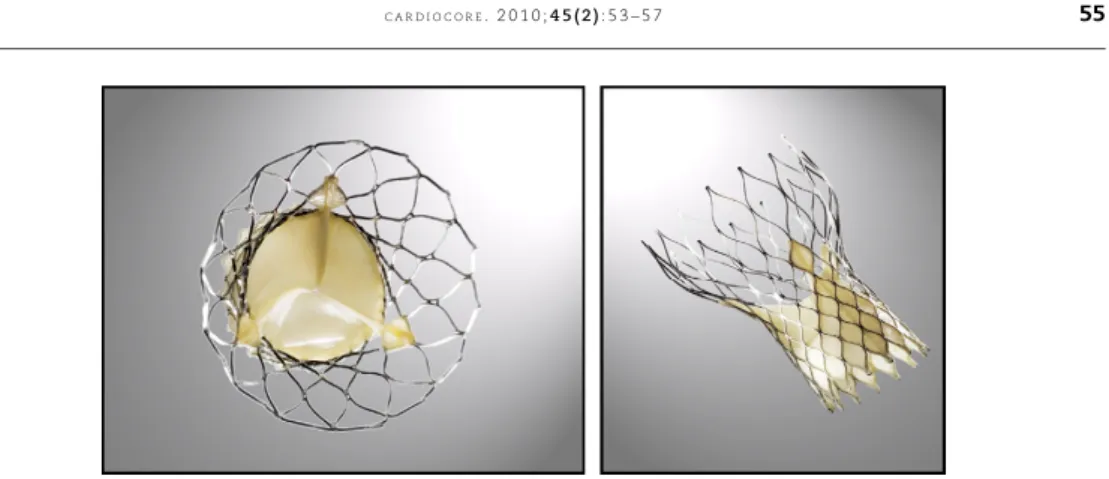 Figura 2 – Pro´tesis autoexpandible CoreValve.