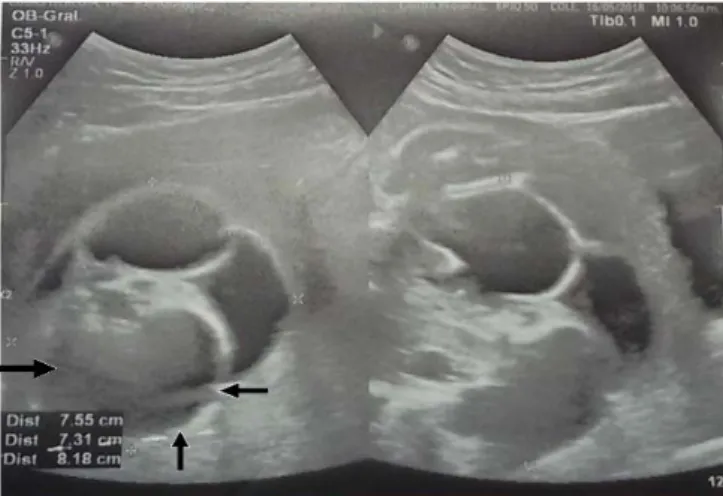 Figura 1. Embarazo gemelar, feto I con teratoma sacrococcígeo gigante, multitabicado, que 