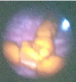 Figura 1. Cistoscopia: imagen en forma de T calcificada 
