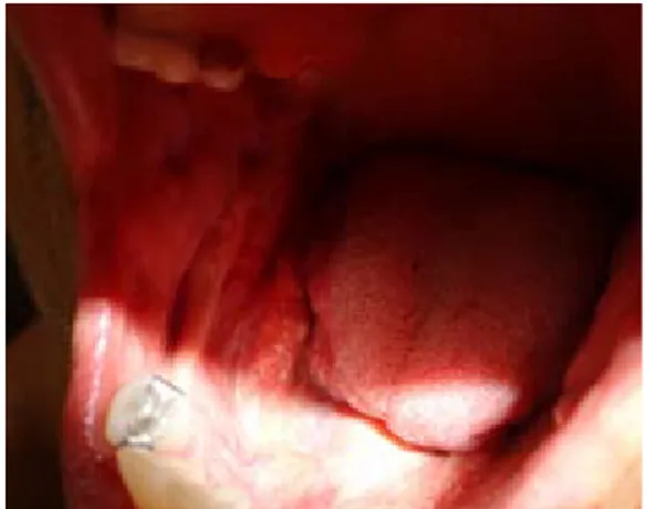Figura 1. Paciente de 62 años de edad con  marcada asimetría facial a expensas de  aumento de volumen de la región mandibular  derecha