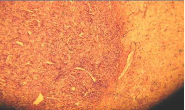 Figura 3.  Examen microscópico: patrón de crecimiento lobular, fibrosis 