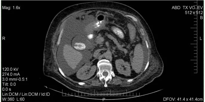 Figura 4. TAC de abdomen 