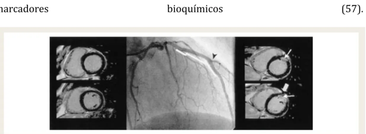 Figura 6. Tomada de Babu et al. Se muestra a la izquierda un eje corto de ventrículo  izquierdo  en  una  cardioresonancia  resonancia  antes  de  una  coronariografía  y  angioplastia sobre lesión bifurcada de descendente anterior-diagonal cuya imagen  se