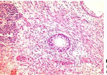 Figura 1.  Teratoma 