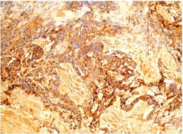 Figura 4. Tumor del seno 