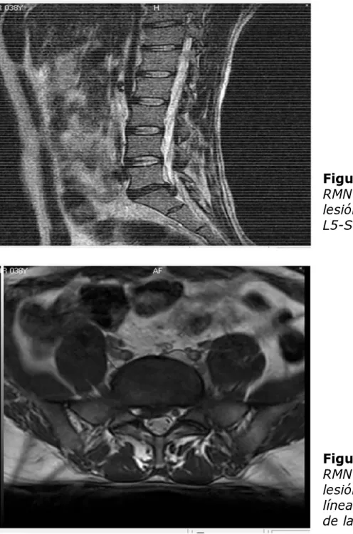 Figura 1. Vista lateral de la   RMN que demuestra una  lesión hipo intensa a nivel de  L5-S1 