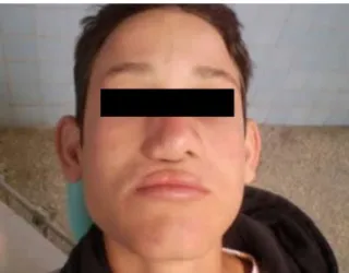 Figura 3. Simetría nasal lograda 