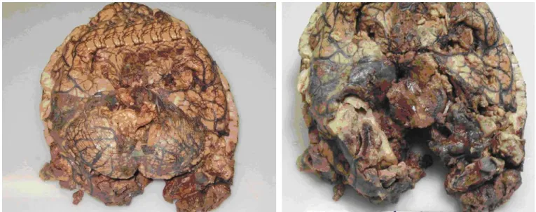 Figura 1. Edema cerebral severo. Áreas 