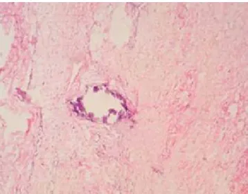 Figura 1:  Biopsia de piel en tinción de hematoxilina-eosina (40X).  Calcificación de capa media de arteriolas de dermis reticular.