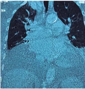 Figura 3.  Tomografía computarizada de tórax y abdomen  que muestra mediastino ensanchado por tejido adiposo y  prominencias vasculares, hígado con dilatación de venas  suprahepáticas (16 mm) y líquido de ascitis perihepático y  en ambas correderas parieto