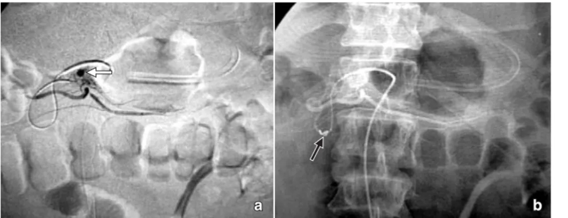 Figura 7. Arteriografía selec-