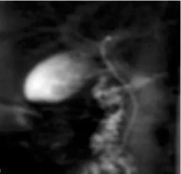 Figura 2. CPRM paciente con litiasis vesicular múltiple.