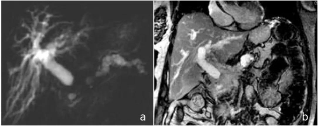 Figura 8. Carcinoma pan-
