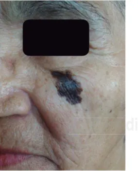Figura 3.  Melanoma en la región facial. Nótese asimetría de  la lesión y mala defi nición de los bordes.