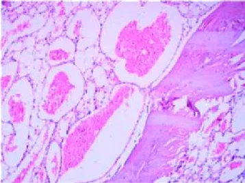 Figura 6. Se aprecia fotografía microscópica del heman- heman-gioma, donde se observan láminas de hueso rodeado de vasos sanguíneos con eritrocitos en su luz.