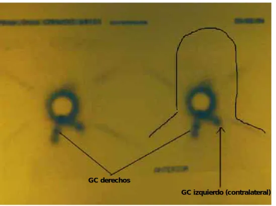 Figura 3. Linfogammagrafía de