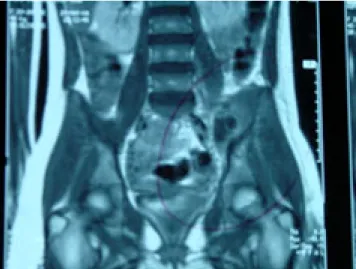Figura 1. RM: Absceso del psoas (4 x 5 cm) con necrosis central.