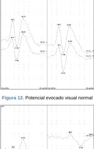 Figura 13. Potencial evocado visual alterado en el ojo derecho 