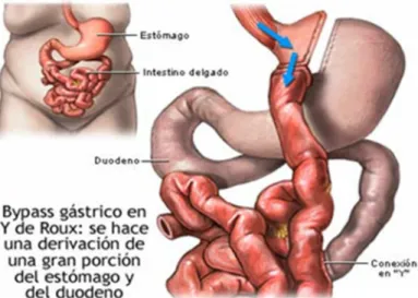 Figura 7: Bypass gástrico 