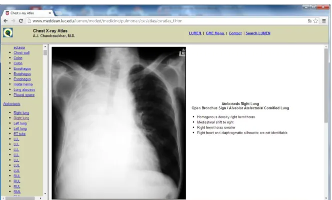 Figura I.41.- Captura de pantalla donde se muestra caso patológico ilustrado con imagen y descripción de hallazgos  radiológicos
