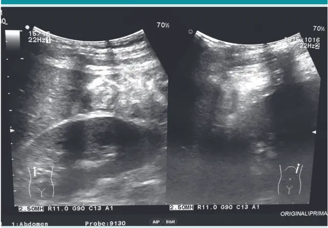 Figura 2.  USG FAST-e, se observa un área hiperecoica entre la cara inferior del lóbulo derecho hepático y el  polo superior del riñón derecho; es la imagen clásica de líquido libre en el espacio de Morrison.