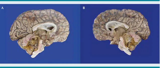 Figura 6.  Encéfalo.  A)  Corte sagital hemisferio izquierdo.  B)  Corte sagital hemisferio derecho.