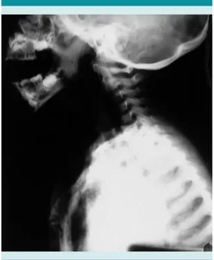 Figura 1.   Radiografía  antero-posterior  previa  a  intu- intu-bación.