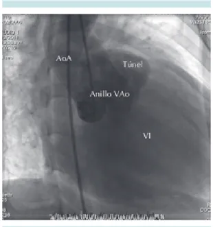 Figura 3. Aortograma en proyección oblicua anterior  derecha:  túnel  aorto-ventricular  izquierdo