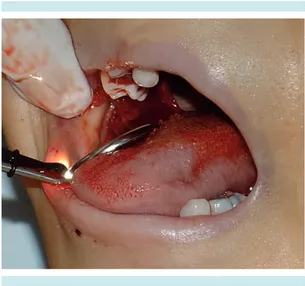 Figura 1.  A la exploración intraoral se observa coágulo  exofítico  relacionado con sangrado en paladar duro  del lado derecho.