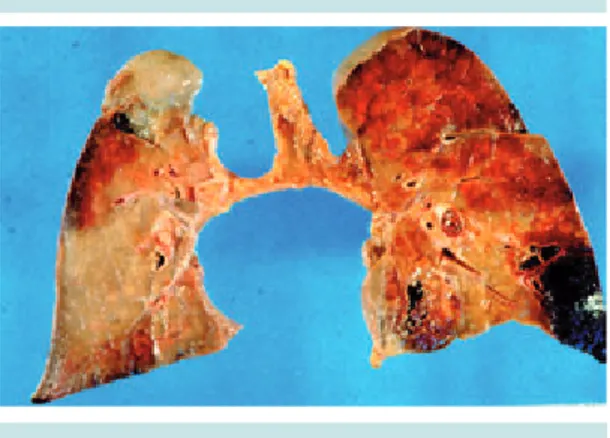 Figura 2.  Infarto antiguo en núcleos basales izquier- izquier-dos.  A)  Proliferación de astrocitos gemistocíticos