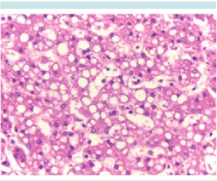 Figura 4.  Hígado: esteatosis de gota gruesa (90%).