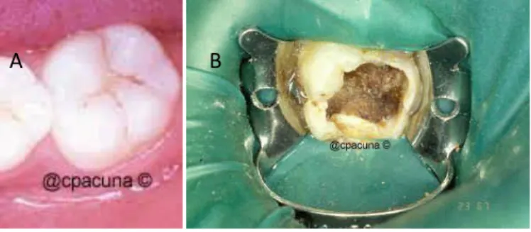 Figura 6.  Localizacion. A fosas y fisuras. B. superficies lisas, interproximales.  Estado de Caries