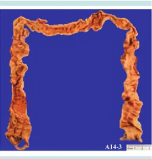 Figura 5.  Imagen que muestra múltiples áreas de co- co-loración pálida correspondientes a zonas isquémicas  de la mucosa.