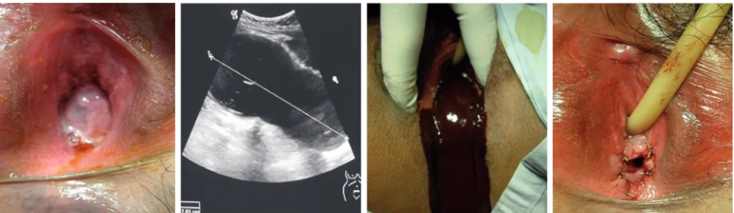 Figura  4A.  Introito  vaginal  con 